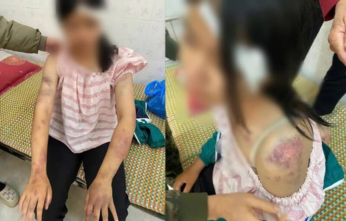 PHẪN NỘ TỘT CÙNG Bà nội đánh đập bạo hành cháu gái 12 tuổi phải nhập viện PHẪN NỘ TỘT CÙNG Bà nội đánh đập bạo hành cháu gái 12 tuổi phải nhập viện